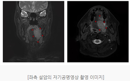 목에 뭐가 걸린느낌 설암 검사 치료방법 - 도움이 되는 블로그