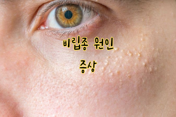 비립종 원인 증상