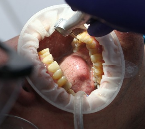 치아 신경치료 과정3