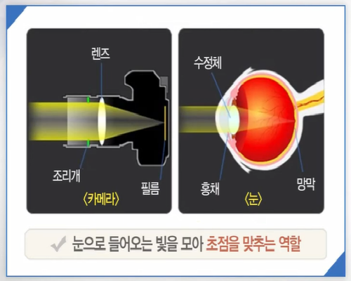 백내장 수술