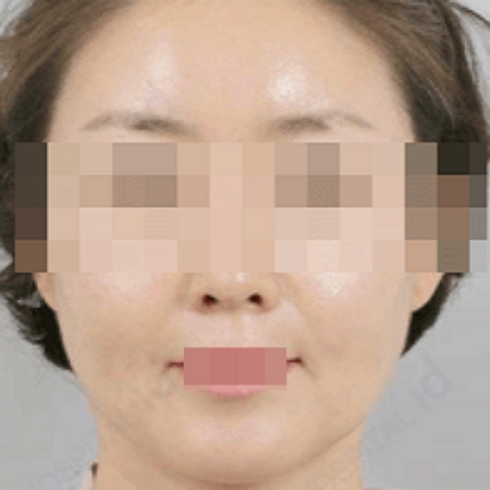 인모드 리프팅 시술 후 여성의 모습 사진
