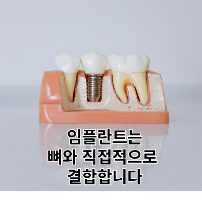 임플란트-구조-썸네일