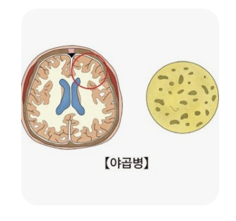 크로이츠펠트-야코병