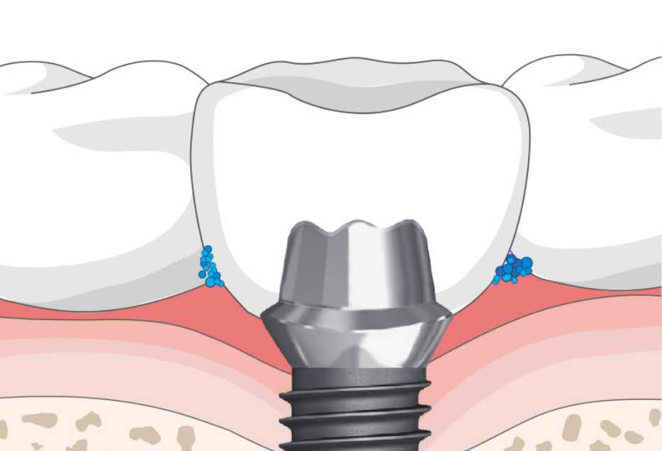 임플란트-주위염-치료하는-3가지-방법