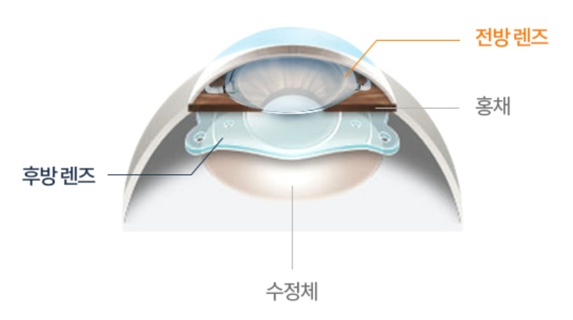 라식 라섹 차이점 비용 최저가 찾기 꿀Tip