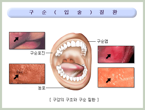 구순염 유발 원인