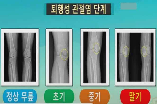  퇴행성 관절염과 류마티스 관절염의 차이를 알고 구별하기