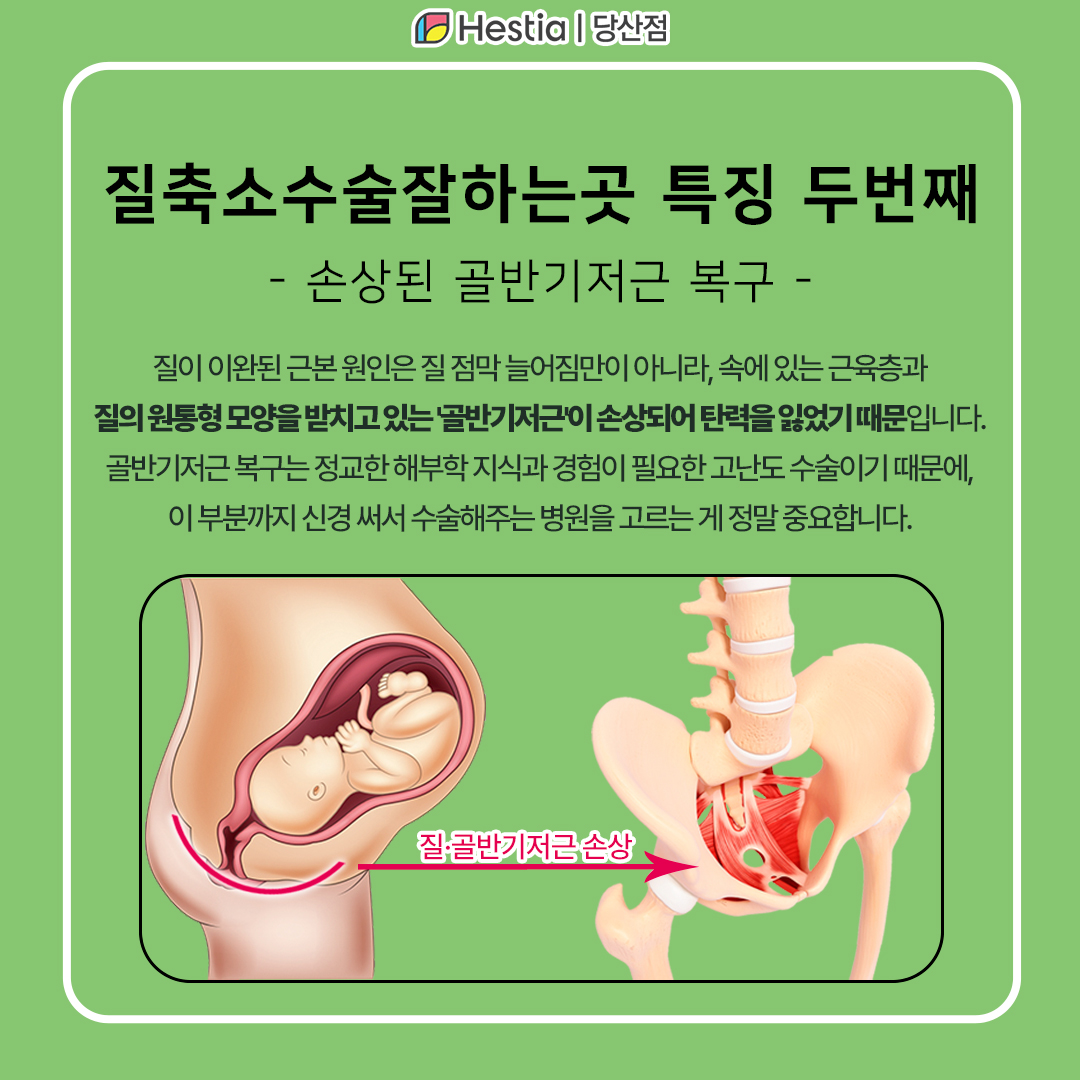 질축소수술잘하는곳 특징 두번째, 손상된 골반기저근 복구