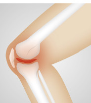 무릎 관절에 좋은 음식