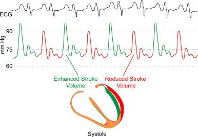 pulsus alternans : 수축능력저하 시사