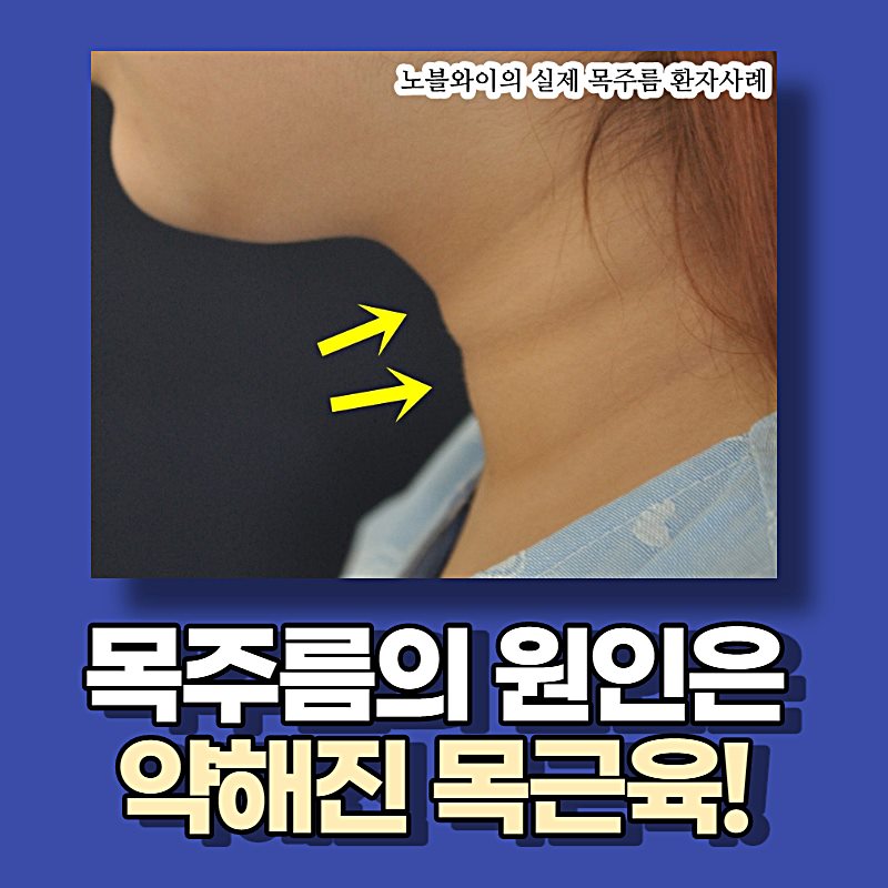  목주름거상술 꼭 안면거상과 같이해야할까
