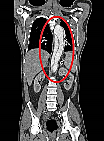 대동맥박리 환자의 X-RAY 사진