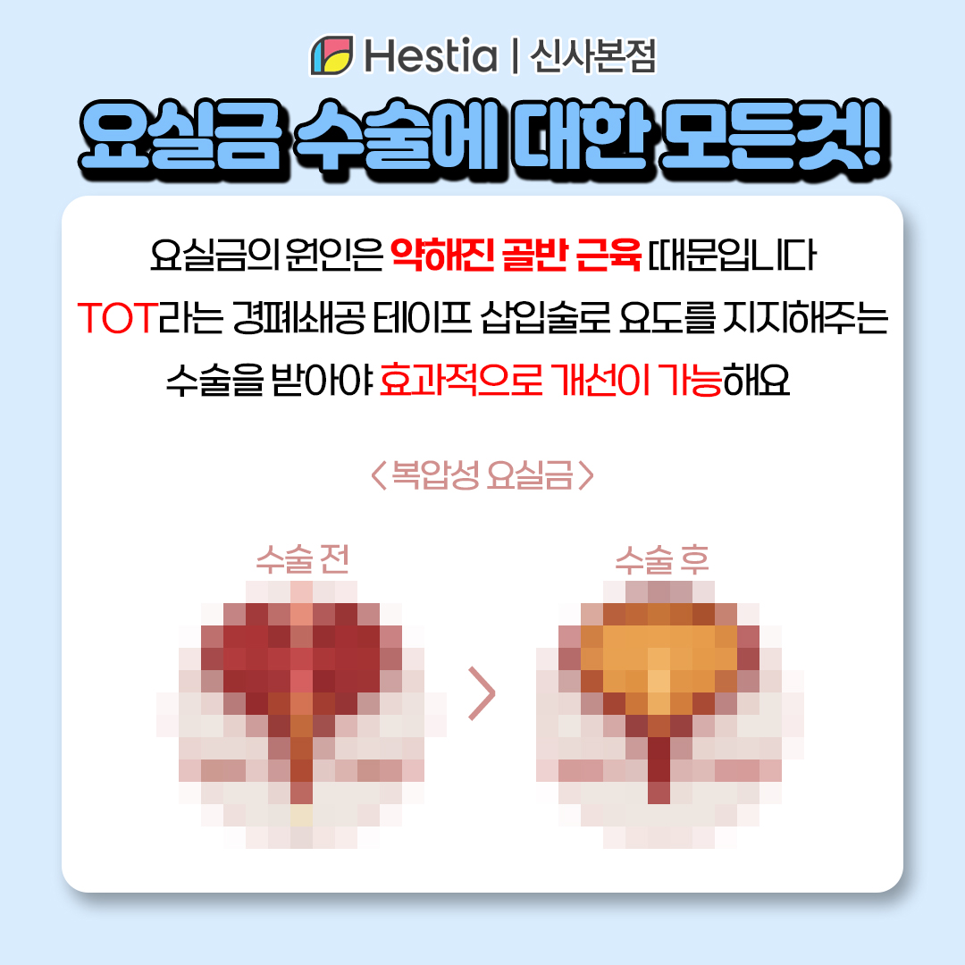요실금검사 골반바닥근육 요실금 수술은 이렇게!