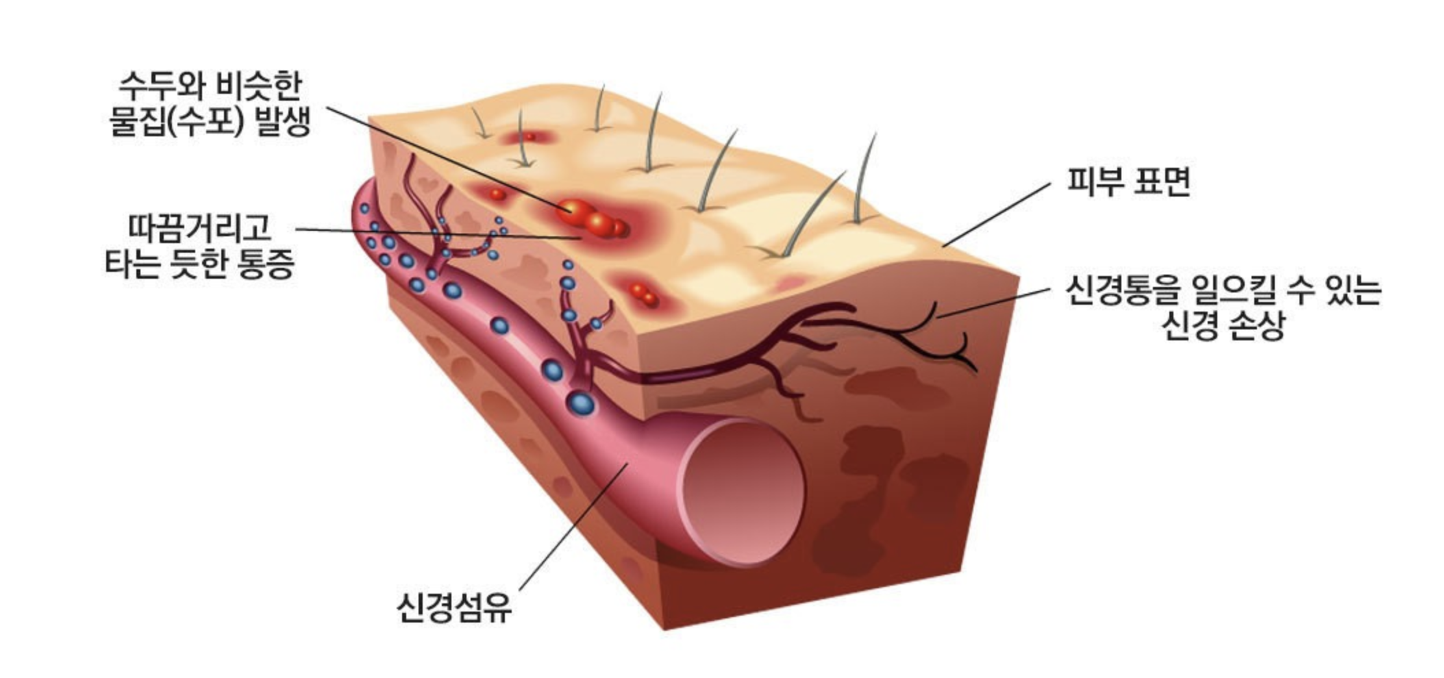 대상포진 초기증상 - 사진