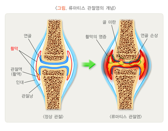  류마티스 관절염