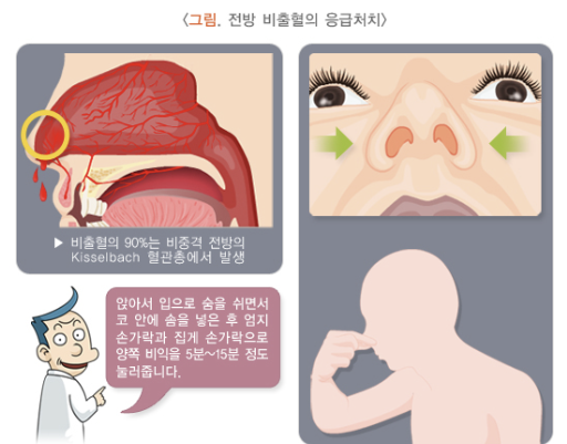 코에서 피가 나는 현상에 대한 이해