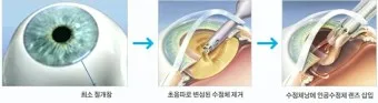 백내장 수술비용 가격 증상_5