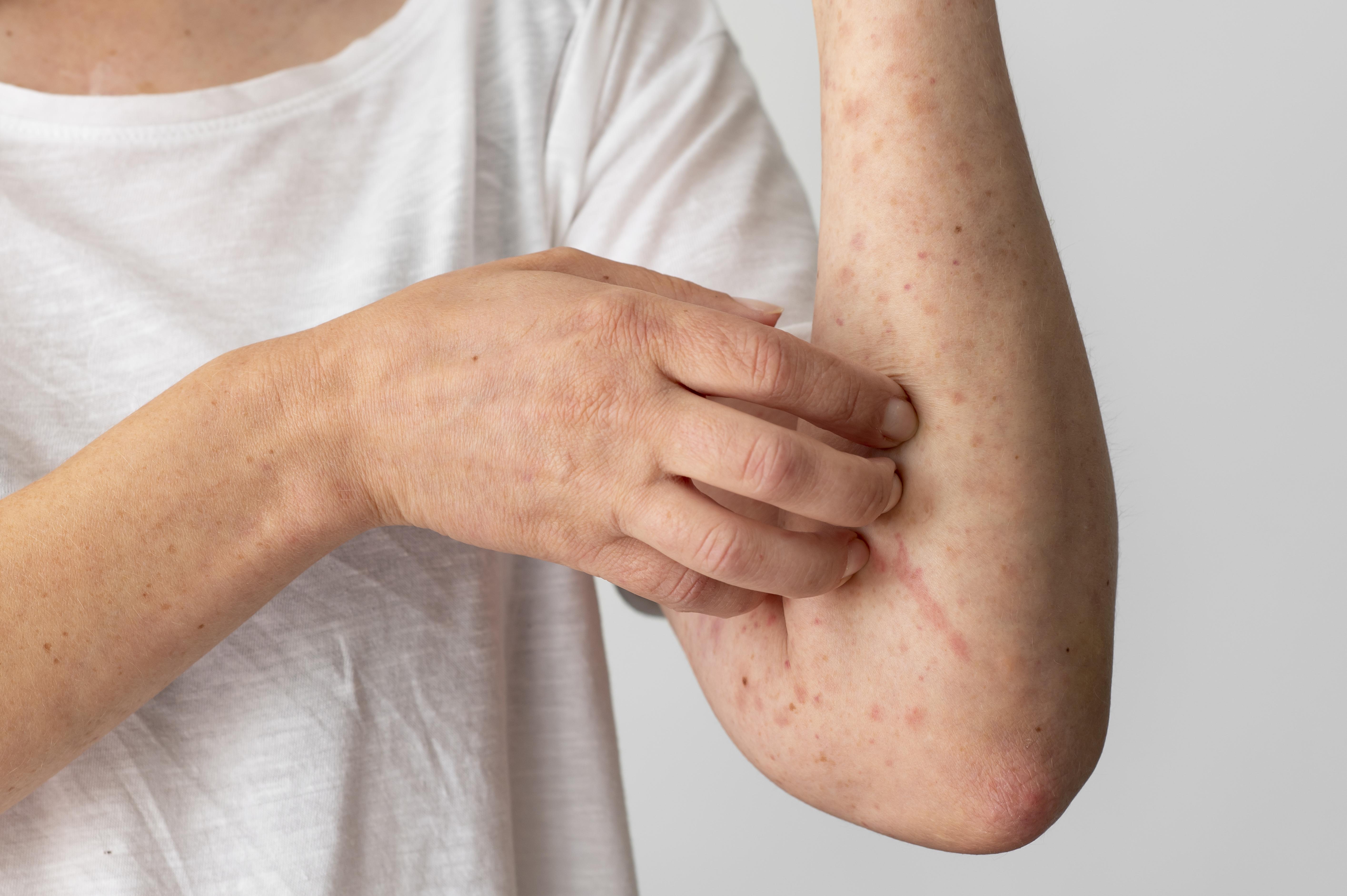알레르기가 있는 환자가 팔의 피부에 알레르기성 가려움증 때문에 가려워서 긁고 있는 사진 (skin-allergy-reaction-person-s-arm)