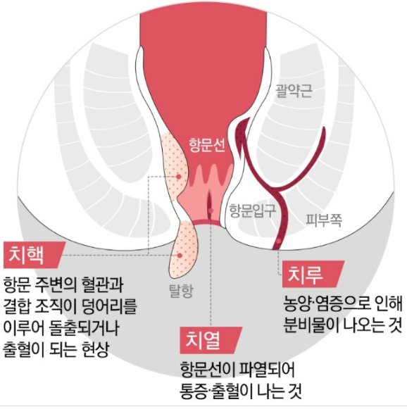 치질 자가치료법