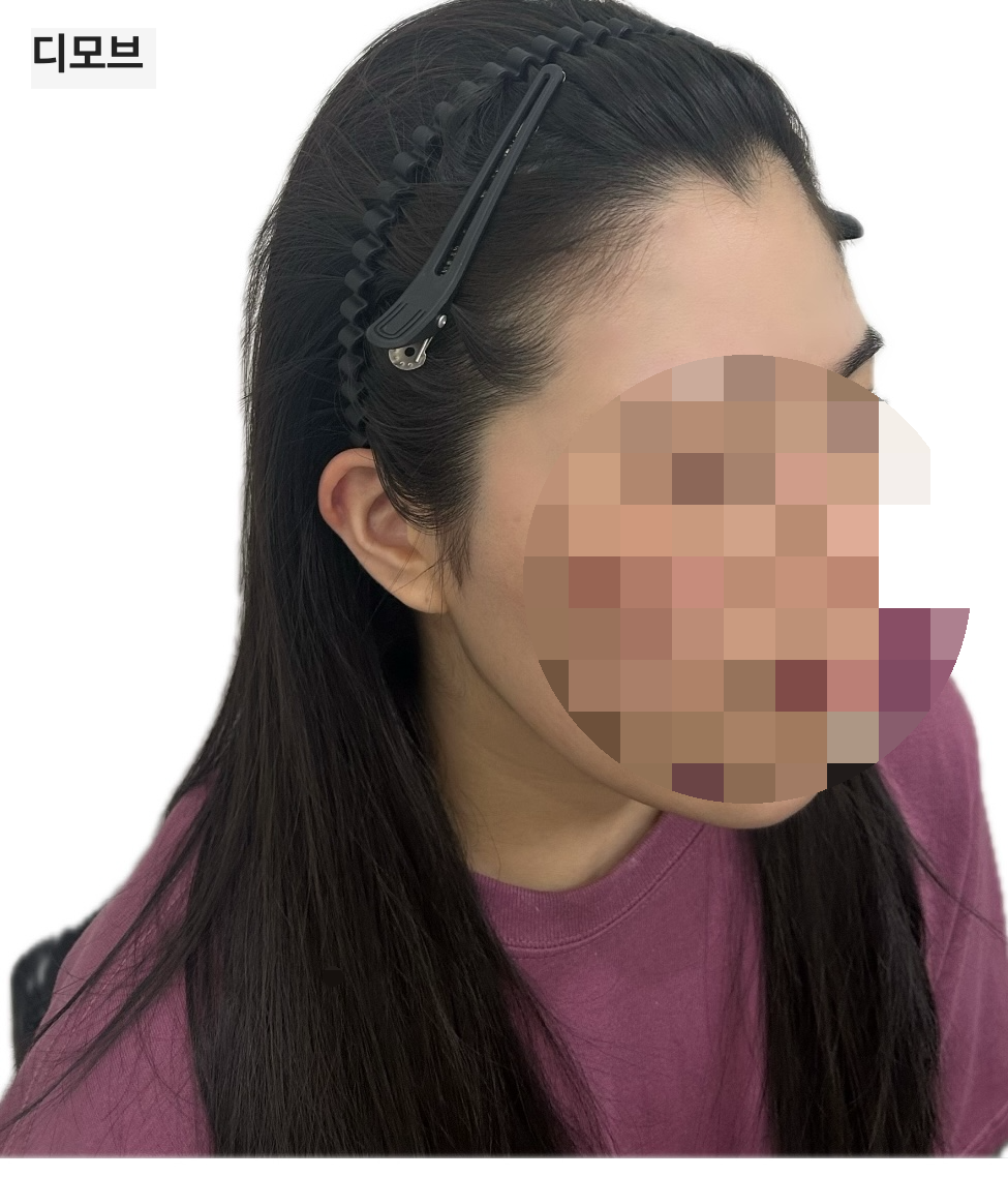 헤어라인 이미지