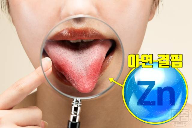 입이 떫은 증상 혀가 화끈거려요 구강작열감증후군 원인 비타민결핍