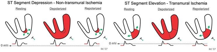 STEMI와 NSTEMI의 ECG