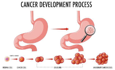 위암 진행과정