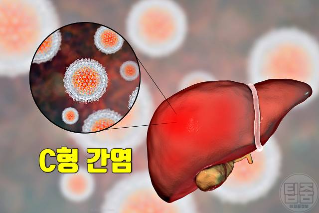 간암 원인 c형간염 40대 50대 간암 예방법