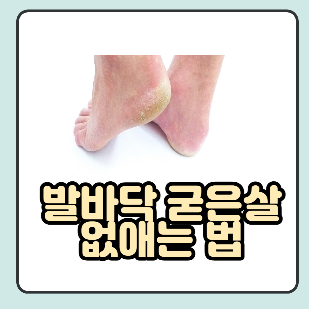  발바닥 굳은살 없애는법 5가지 자세하게 정리