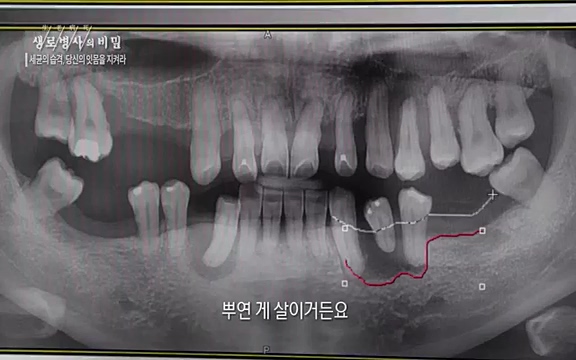 [792회] 생로병사의 비밀 - KBS[세균의 습격, 당신의 잇몸을 지켜라!] 감기보다 병원을 더 자주 찾게 만드는 질병이 있다. 바로 치주질환이다. 2020년 외래 다빈도 질병 1위를 차지한 치은염 및 치주질환 환자는 1,637_20220505_141549.214.jpg