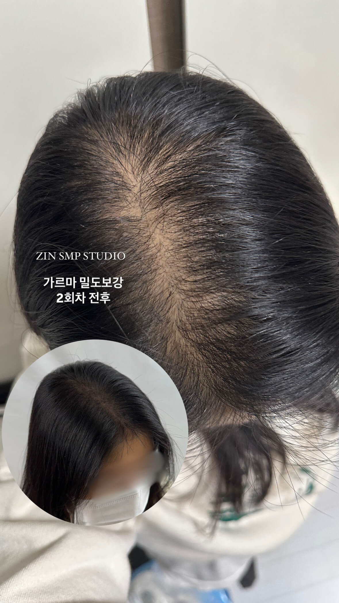 두피문신 잘하는곳