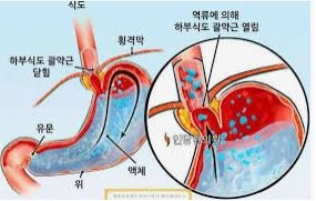  역류성 식도염 증상 알아보기