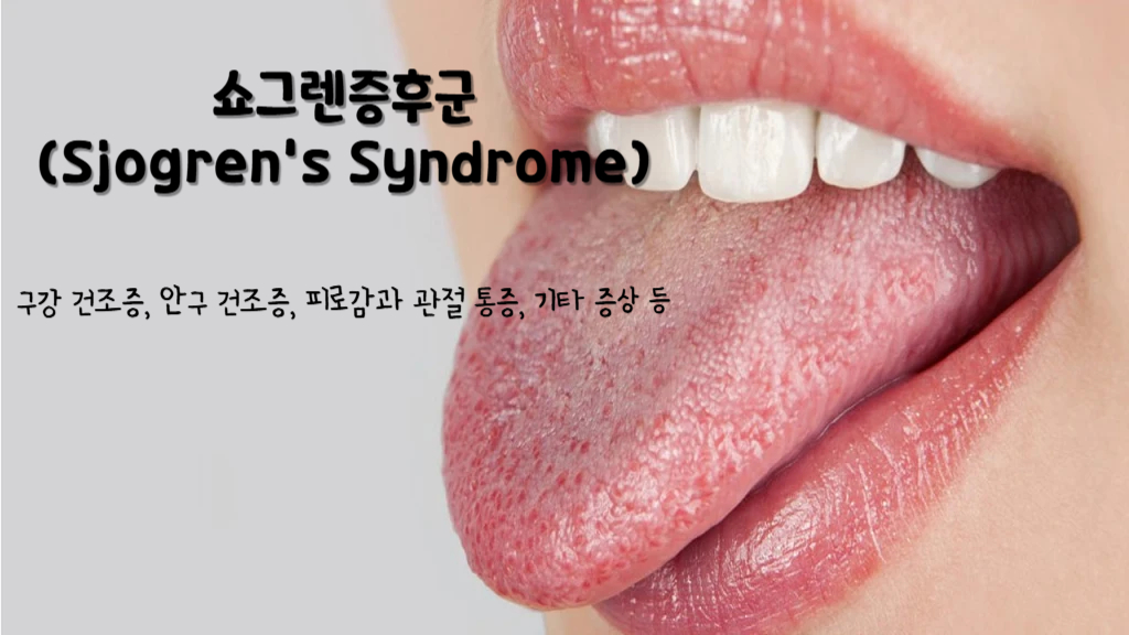 쇼그렌증후군(Sjogren's Syndrome)
쇼그렌증후군 증상 : 구강 건조증, 안구 건조증, 피로감과 관절 통증, 기타 증상 등등