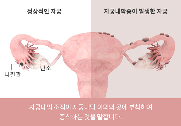 자궁내막증 유전