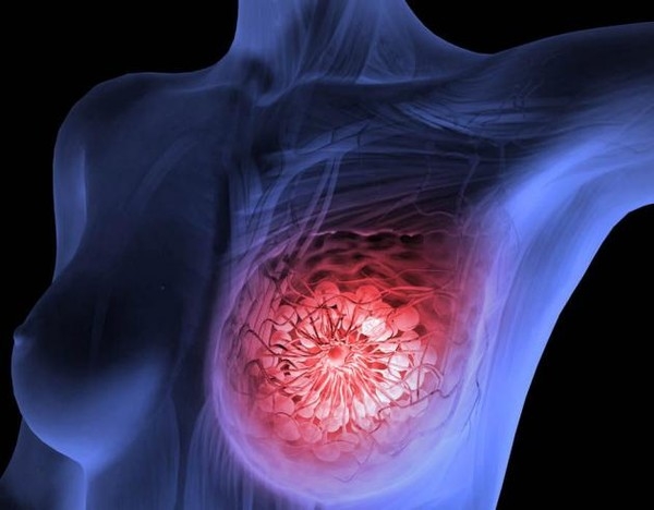 유방암 초기증상 원인 자가진단 정보 총정리2