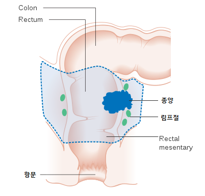 혈변을 본다면 의심부터!! 직장암 초기 증상 및 치료