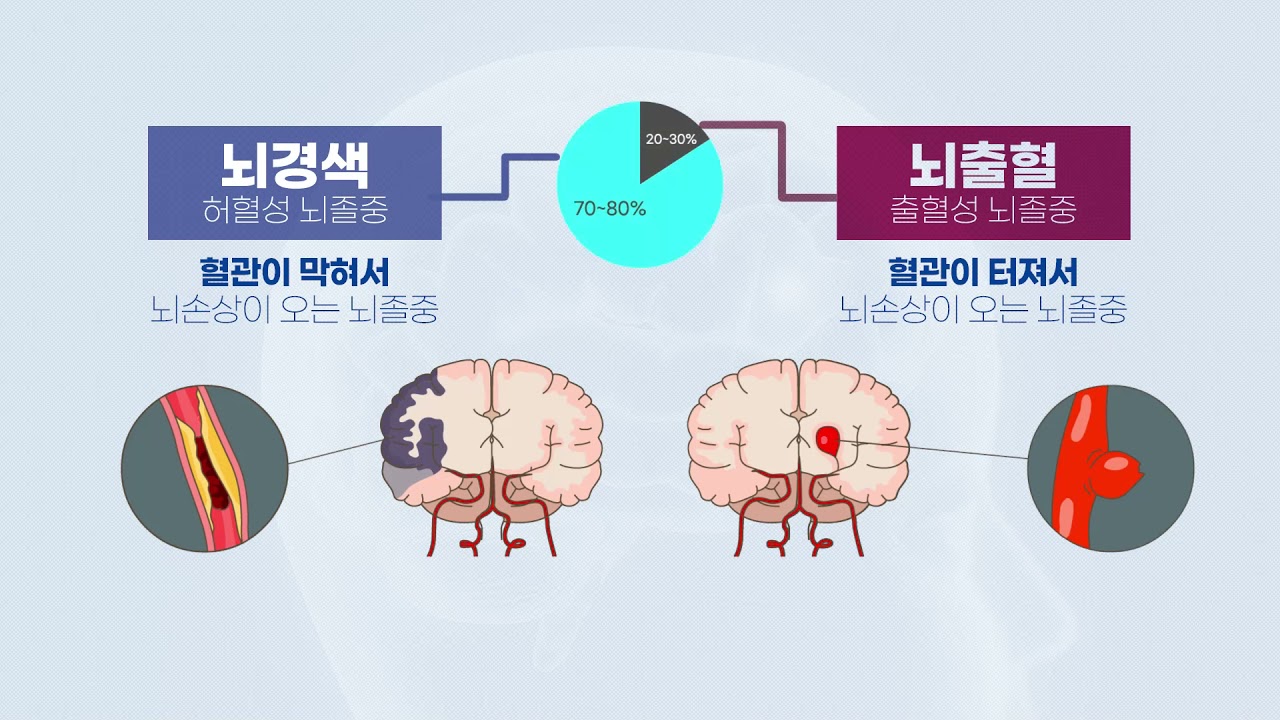 뇌경색 vs 뇌출혈
