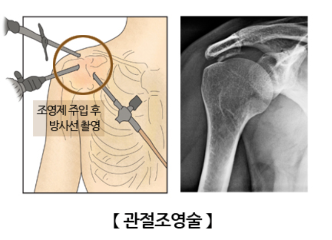 오십견 관절조영술