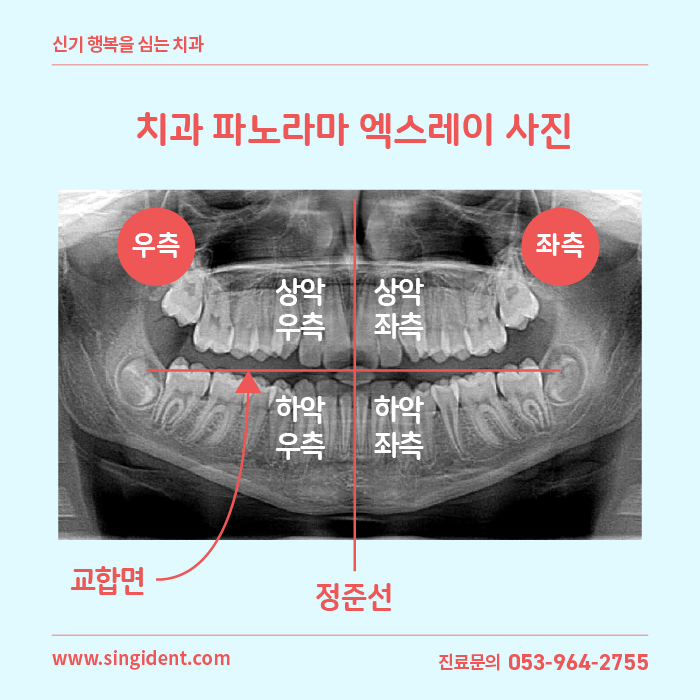 치과 파노라마 엑스레이 사진 - 좌우반전