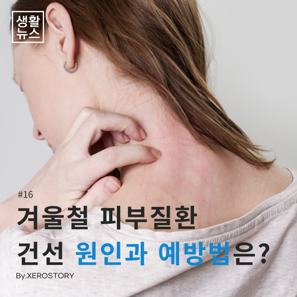  생활건강#16 건조한 겨울철 피부질환, 피부건선의 원인과 치료법은??