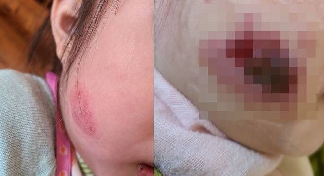  뺨에 물집 생긴 5살 딸, 부모 입장과 의원 입장