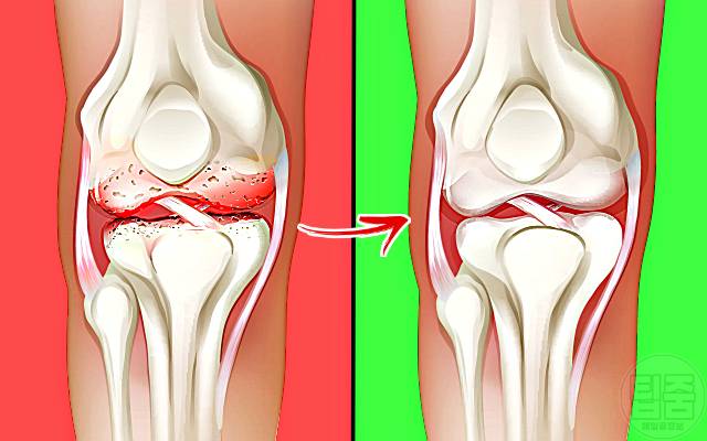 무릎 연골재생 음식 무릎연골에 좋은 음식