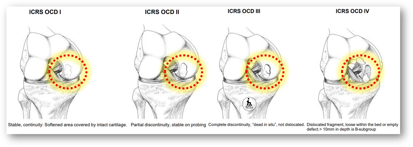 ICRS(International Cartilage Repair Society) grade