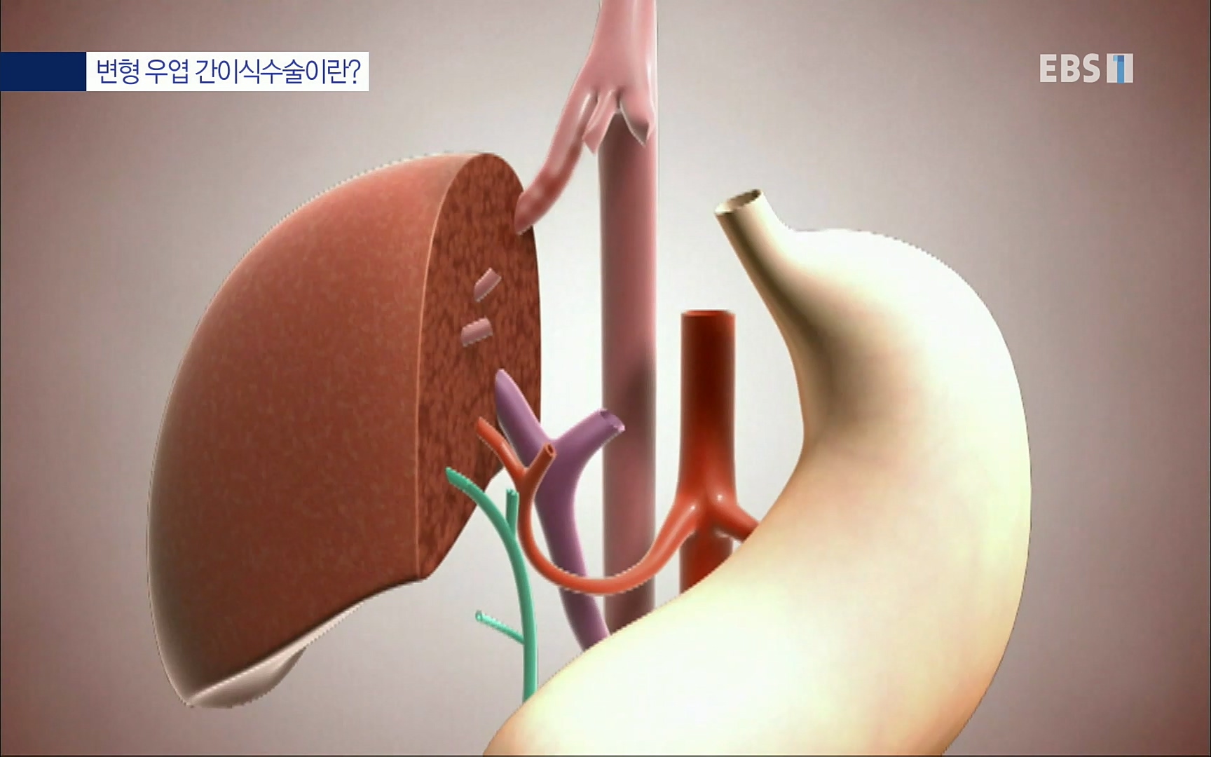 EBS 명의 헬스케어 - TV - 교육의 중심 EBS명의 15년 - 간, 완치에 도전하다.mp4_20220802_202417.496.jpg