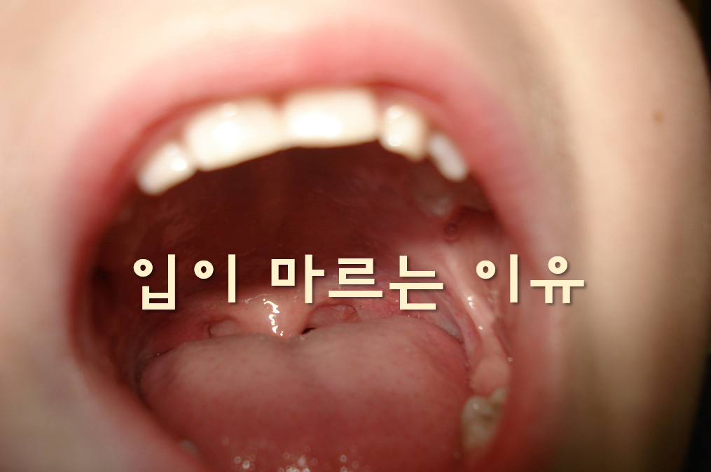  입이 마르는 이유와 마르는 증상의 치료 방법