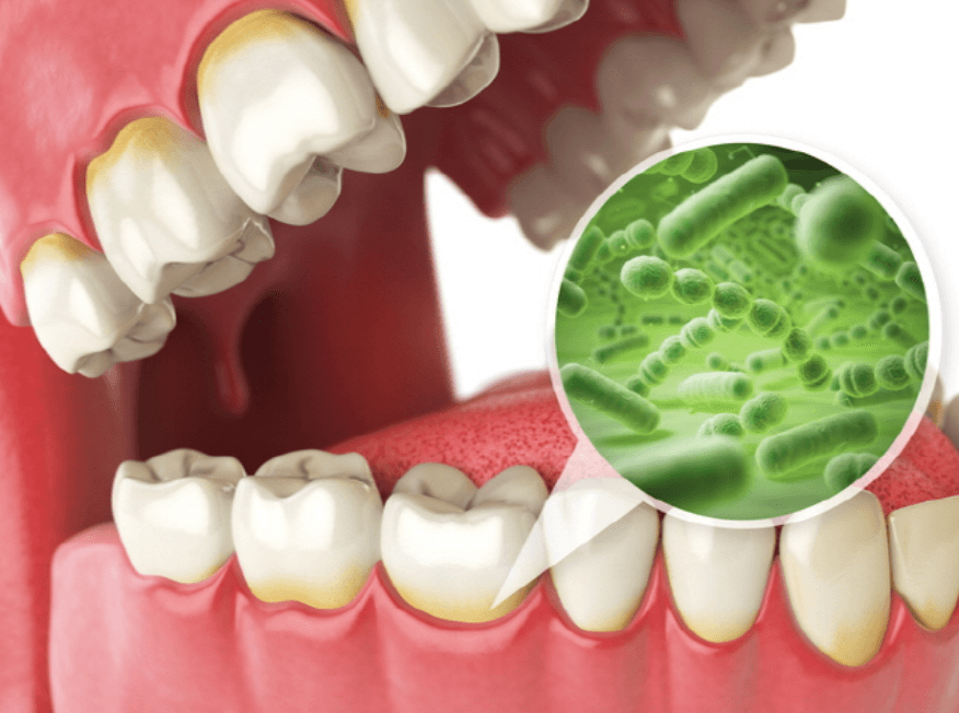 치아-잇몸-구강-유산균-사진