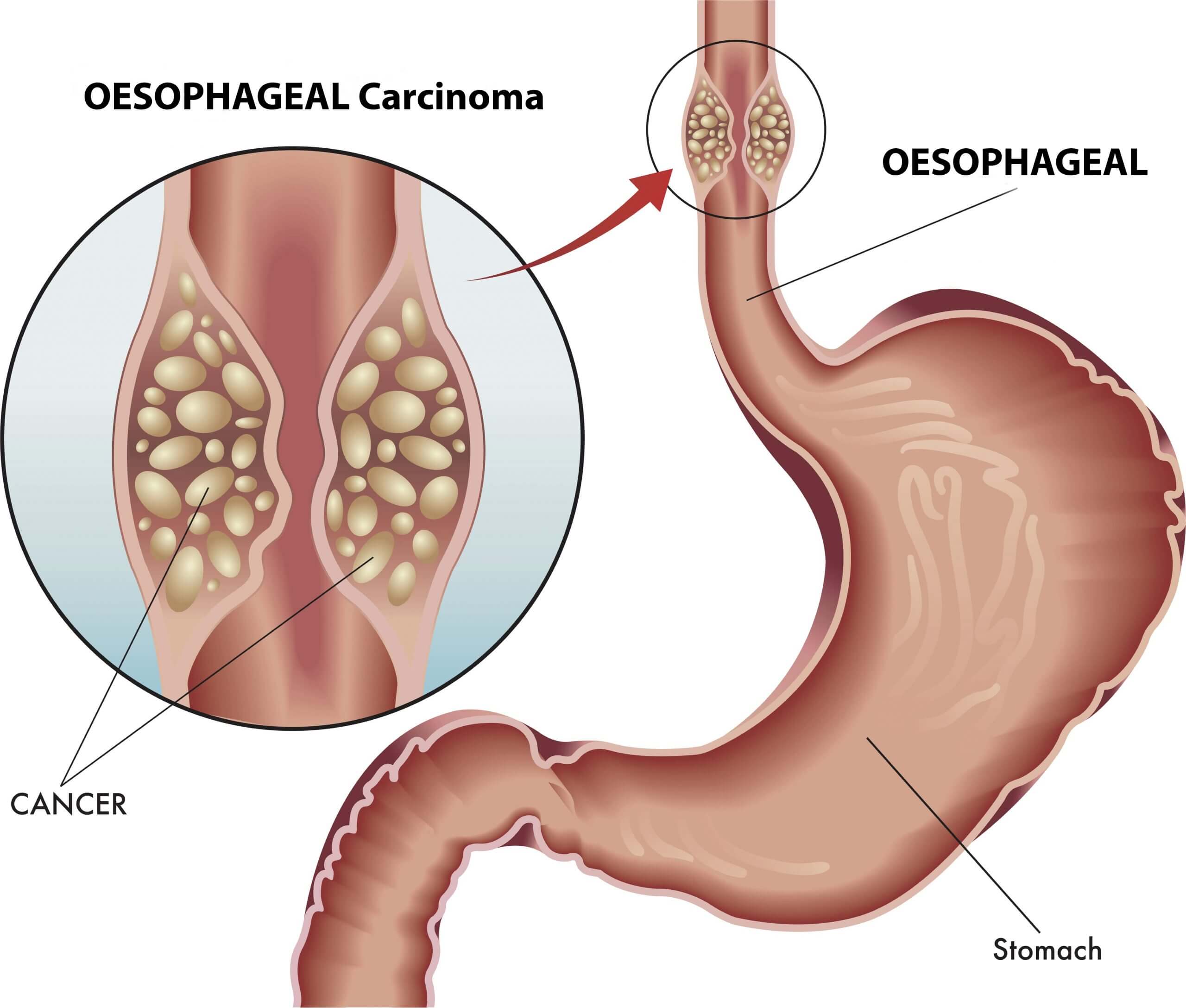 esophageal cancer