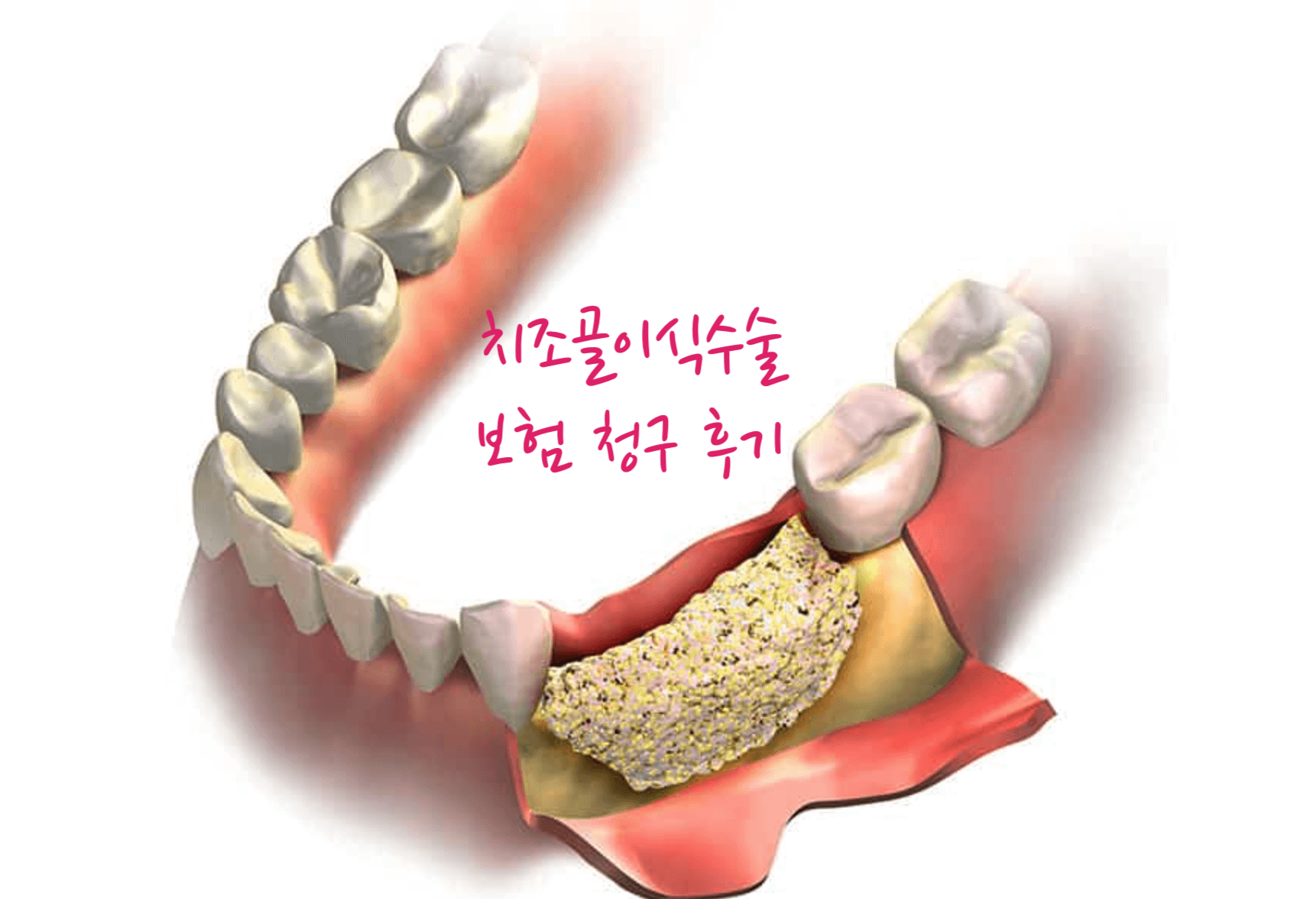 치조골이식수술