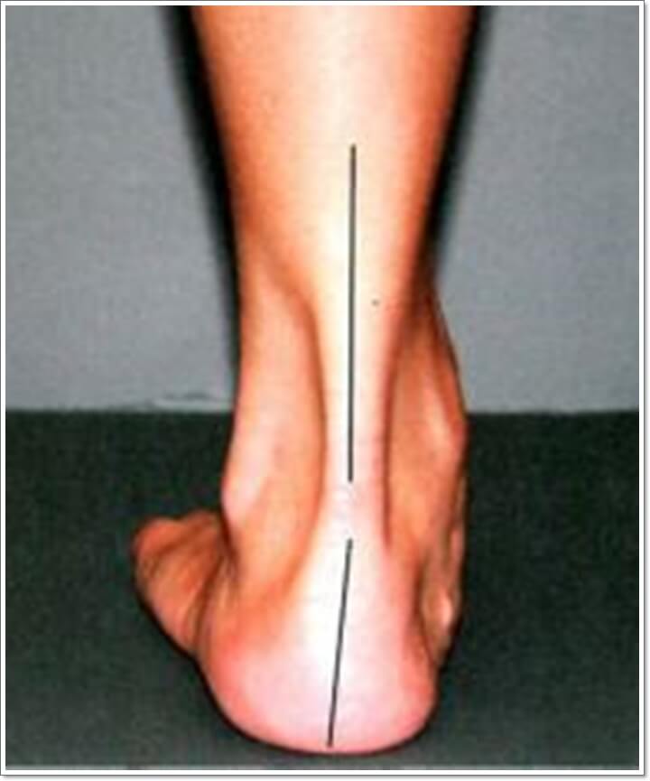 체중지지 상태에서 발의 외번이 나타나 있는 것을 확인 시켜주는 선이 그려져 있는 사진