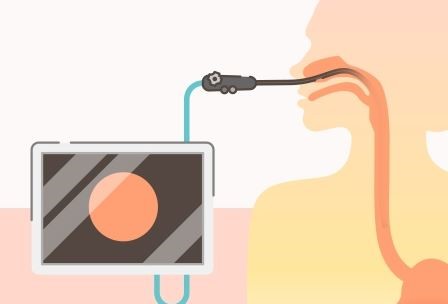 후두-내시경-사진